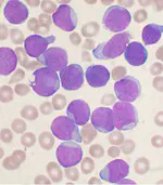 Classification of B-Cell Lymphoblasts versus Normal Cells in White Blood Cells Microscopic Images